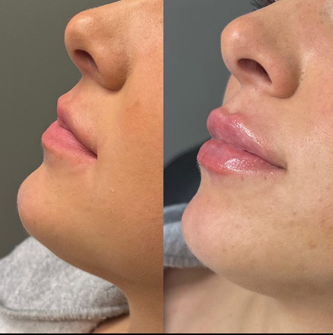 Lip Filler Treatment (Versa)