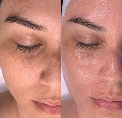HydraFacial Deluxe