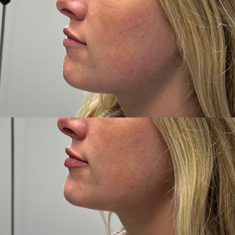 Chin Filler