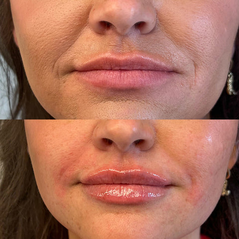 Lip Filler Treatment (Versa)