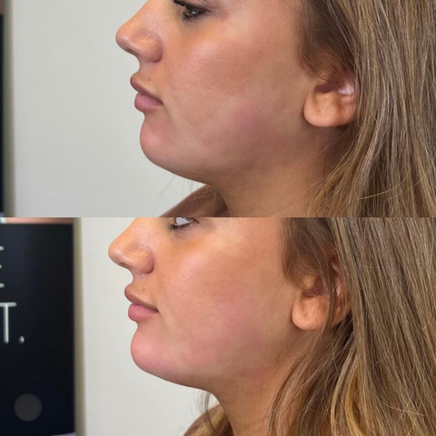 Chin Filler